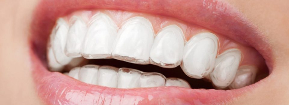 Apparecchi invisibili estetici