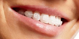 Ortodonzia estetica fissa per adulti