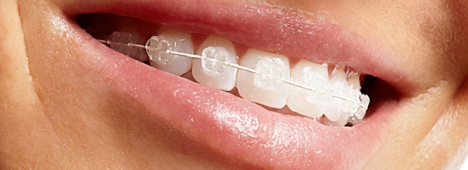 Ortodonzia estetica fissa per adulti