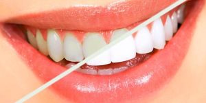 Sbiancamento dentale